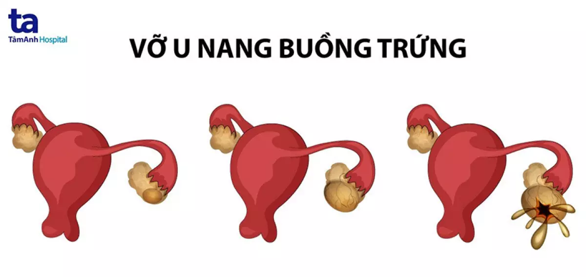 Mô phỏng vỡ u nang buồng trứng